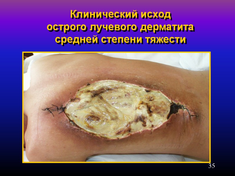 35 Клинический исход  острого лучевого дерматита средней степени тяжести